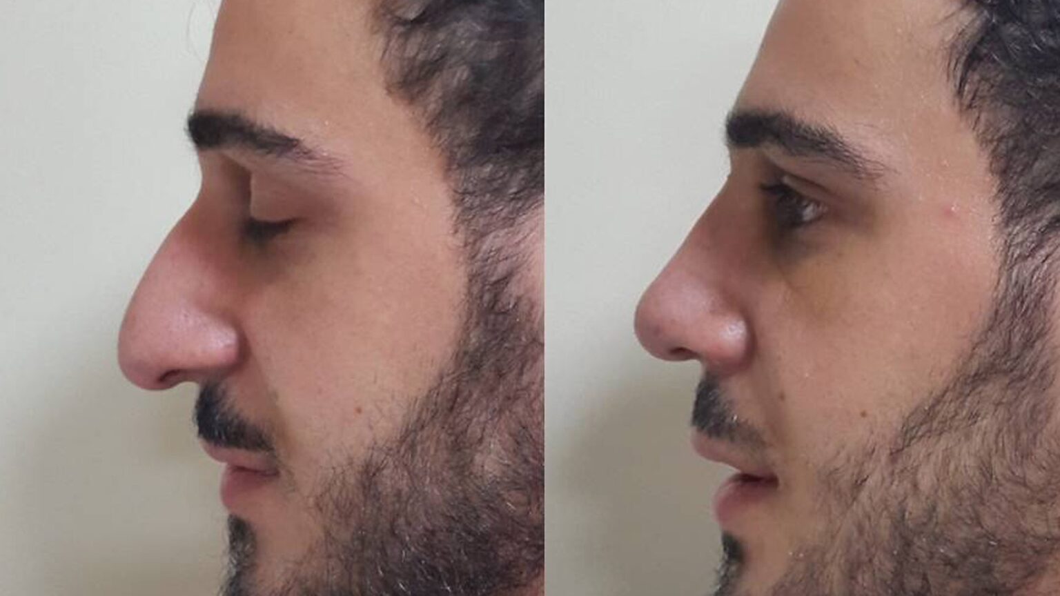Грузинский нос фото в профиль у мужчин